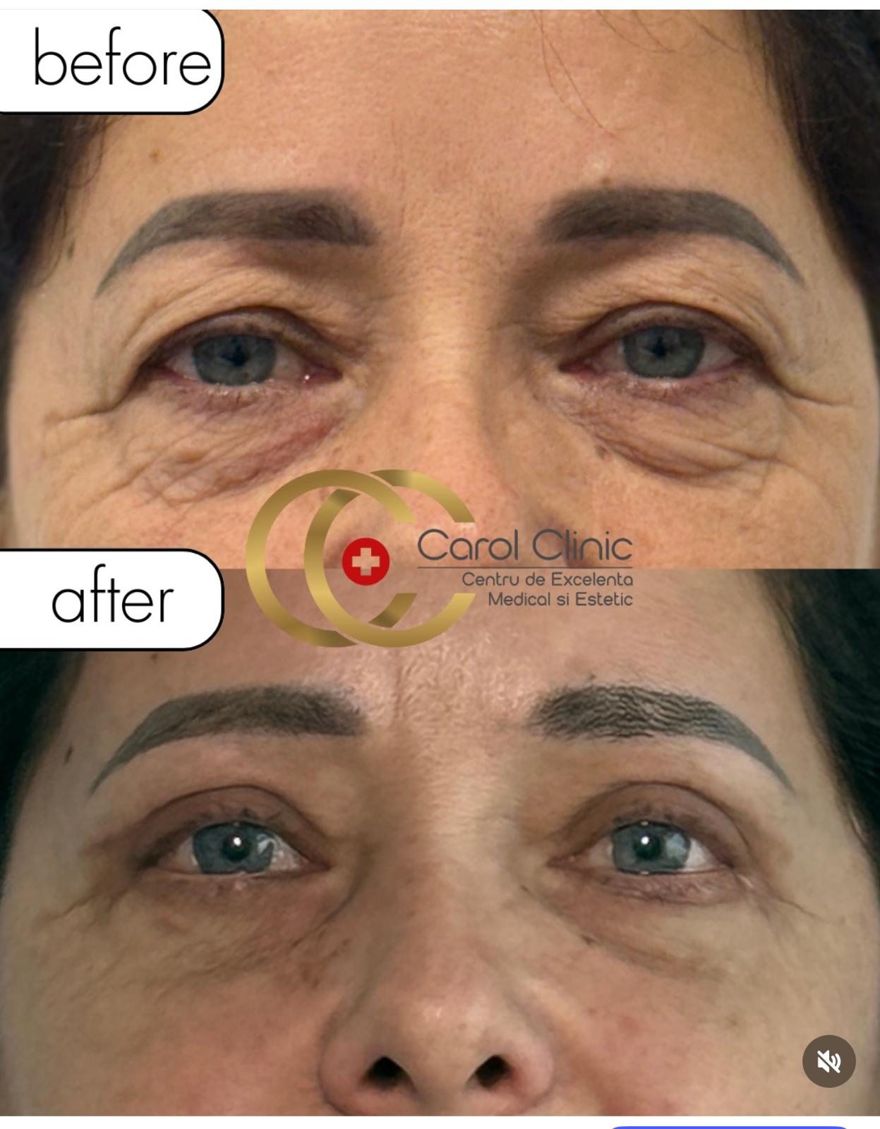 Blefaroplastie rezultat real Carol Clinic